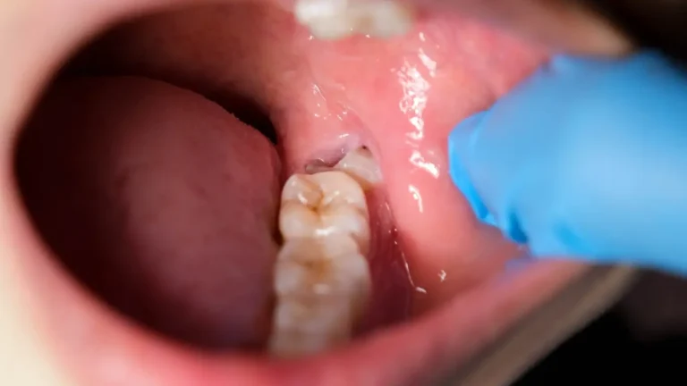 Close-up view of a partially erupted wisdom tooth with inflamed gum tissue