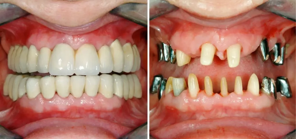Side-by-side before and after full-arch crowns and bridges treatment