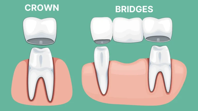 Simple diagram comparing a single dental crown with a three-unit bridge