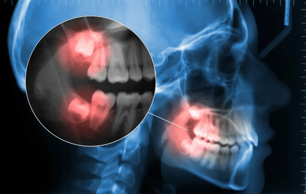 X ray highlighting an impacted lower wisdom tooth in red
