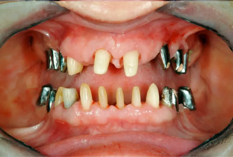 Intra-oral photo of multiple prepared tooth stumps before crown placement
