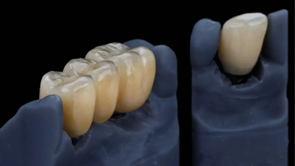 Close-up of zirconia bridge and single crown on blue lab model